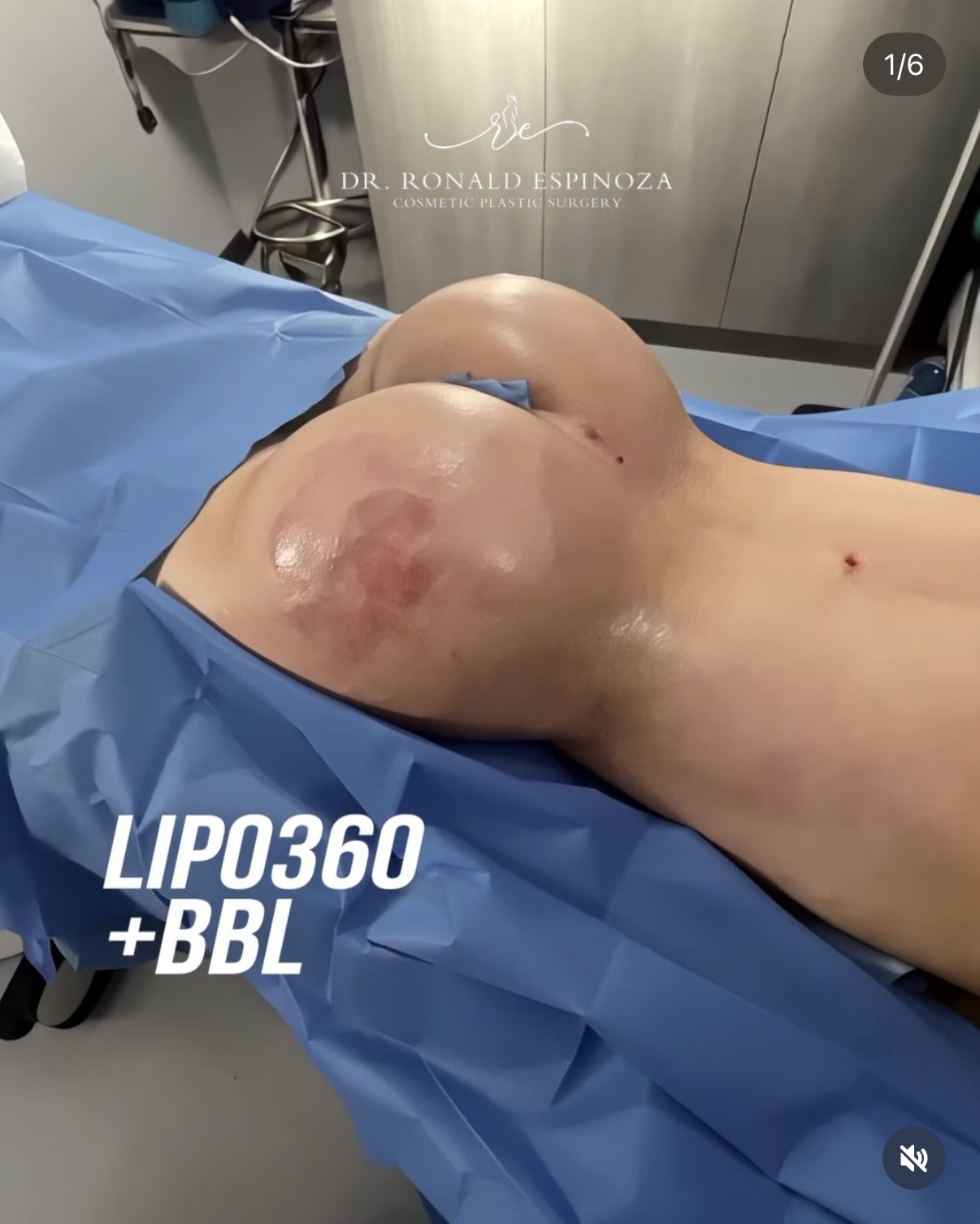 Lipo 360 with BBL side view result by Dr. Ronald Espinoza