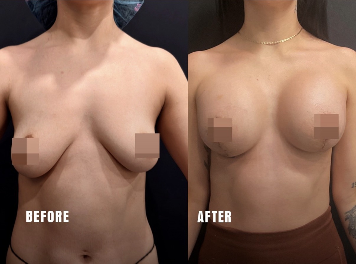 Before and after breast lift with implants, front view, by Dr. Ronald Espinoza