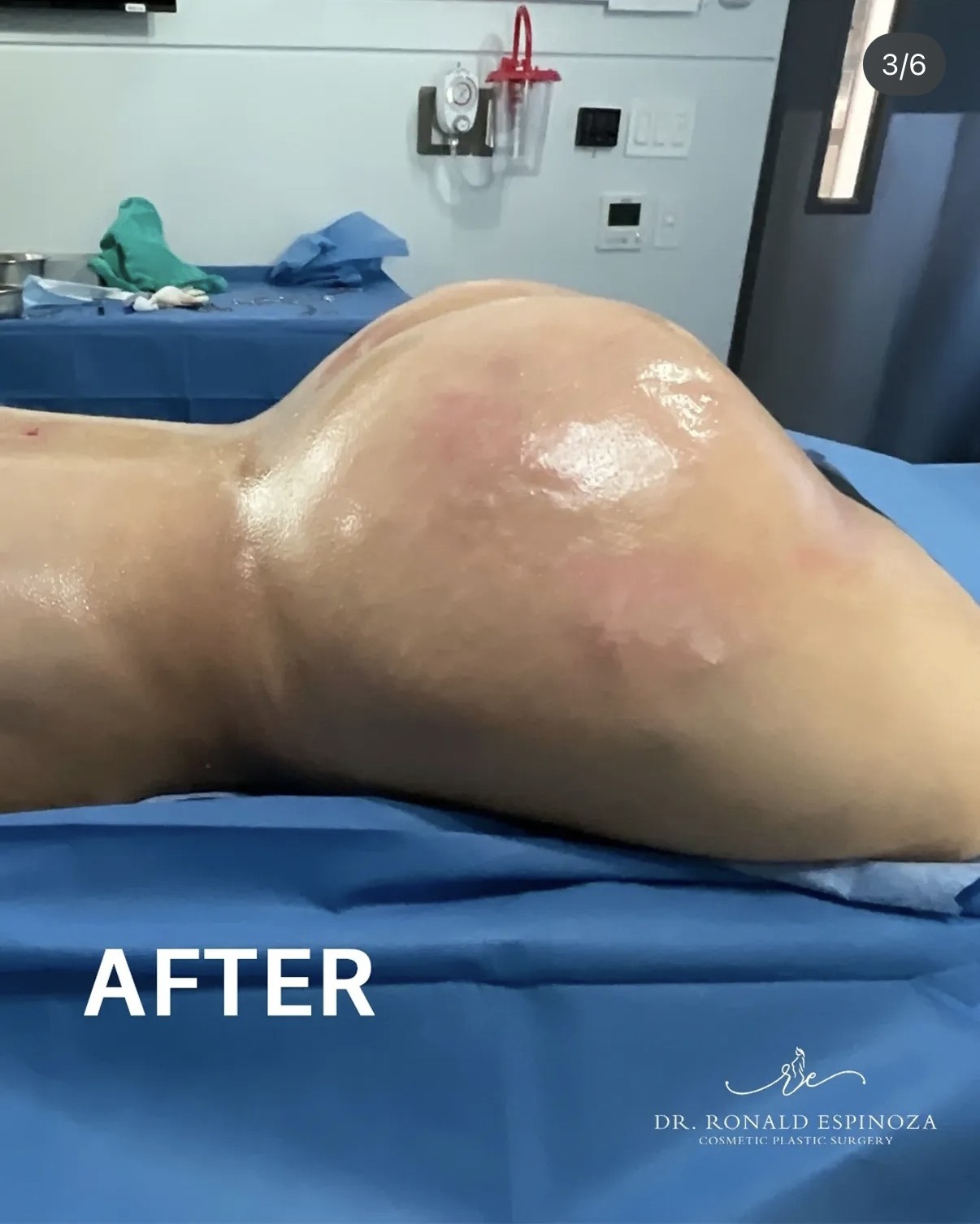 After Brazilian butt lift in the operating room by Dr. Ronald Espinoza