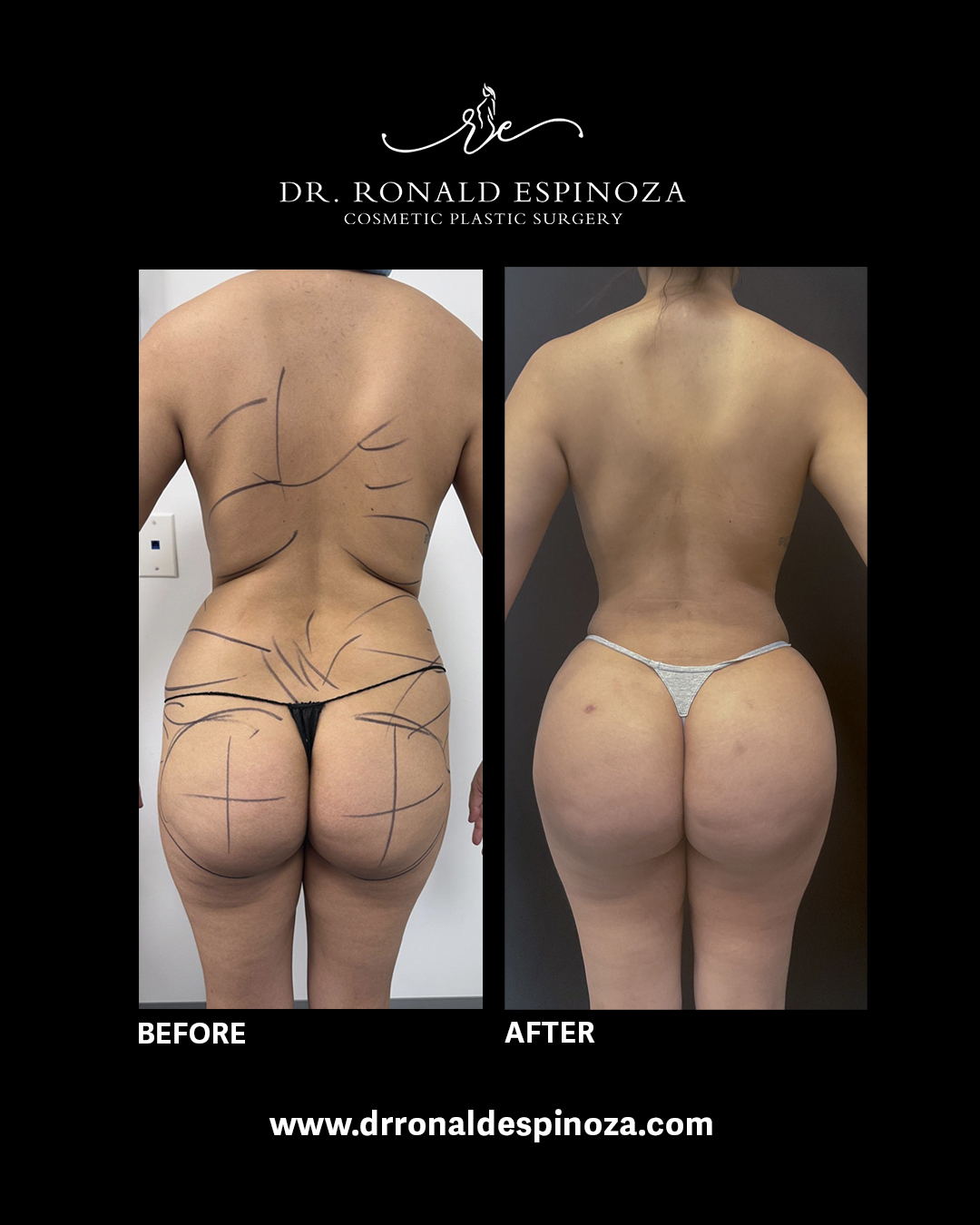 Before and after Brazilian butt lift, back view, by Dr. Ronald Espinoza