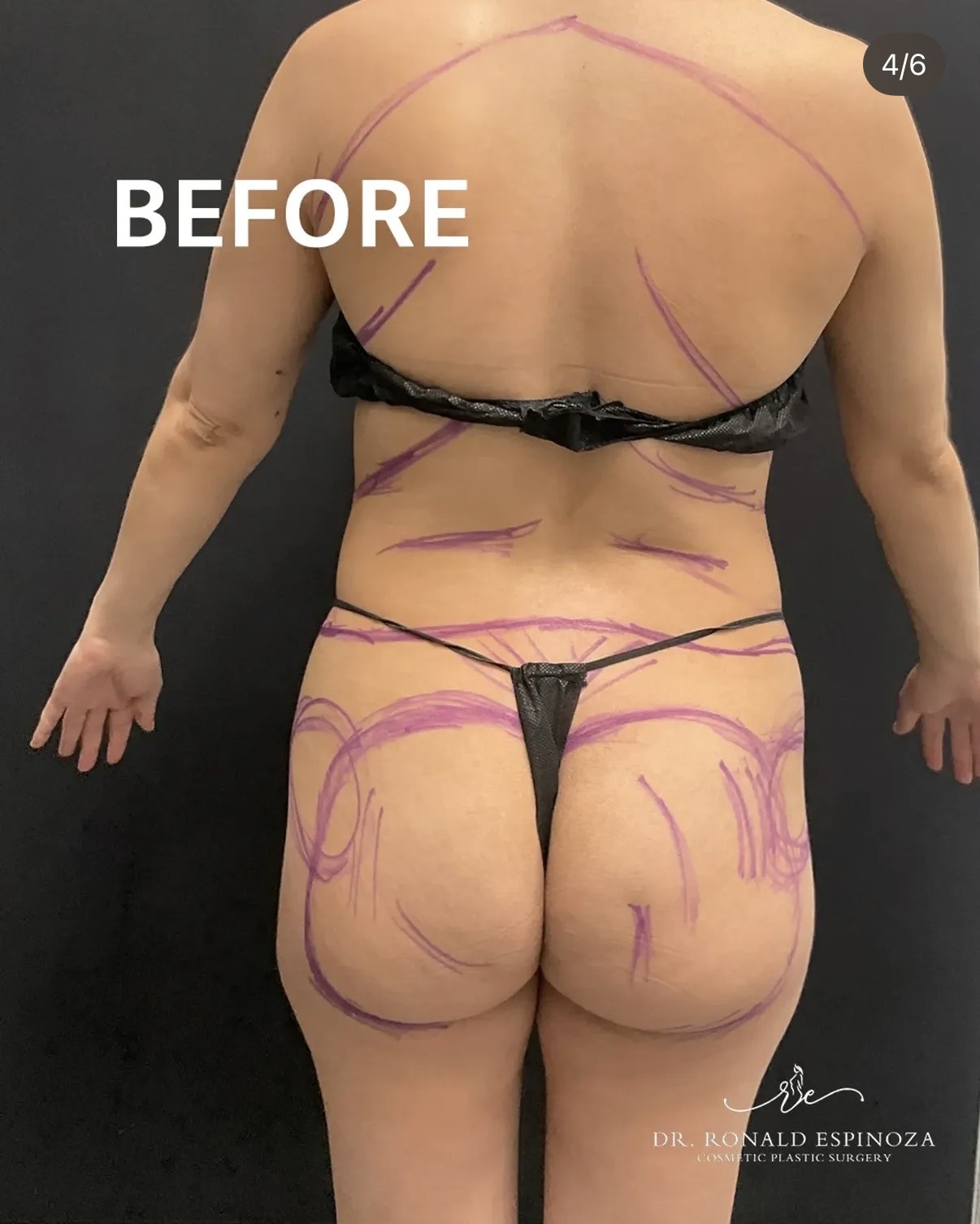 Before photo with full back and flank lipo markings by Dr. Ronald Espinoza