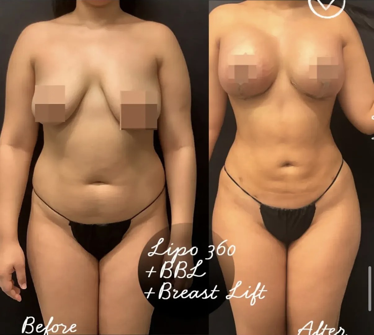 Lipo 360 case photograph by Dr. Ronald Espinoza