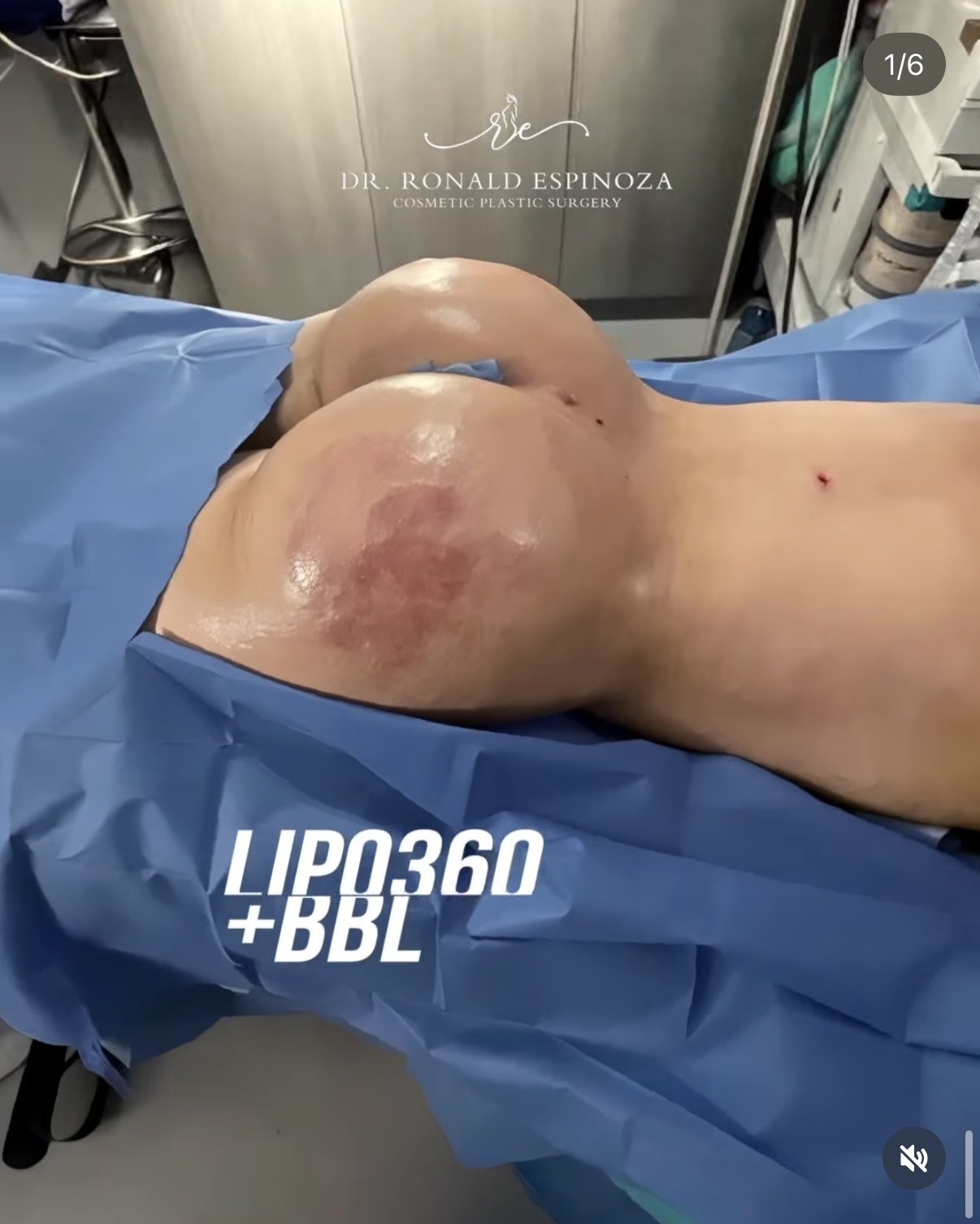 Immediate Lipo 360 with BBL result by Dr. Ronald Espinoza