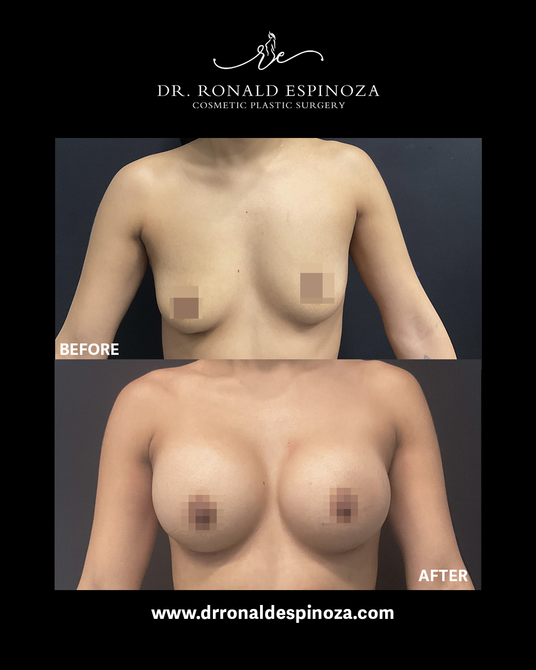 Before and after breast lift with augmentation by Dr. Ronald Espinoza