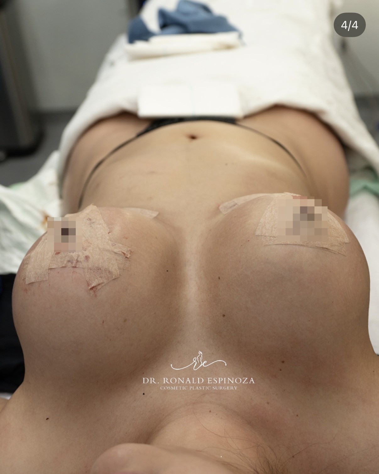 Breast augmentation immediate post-operative result by Dr. Ronald Espinoza