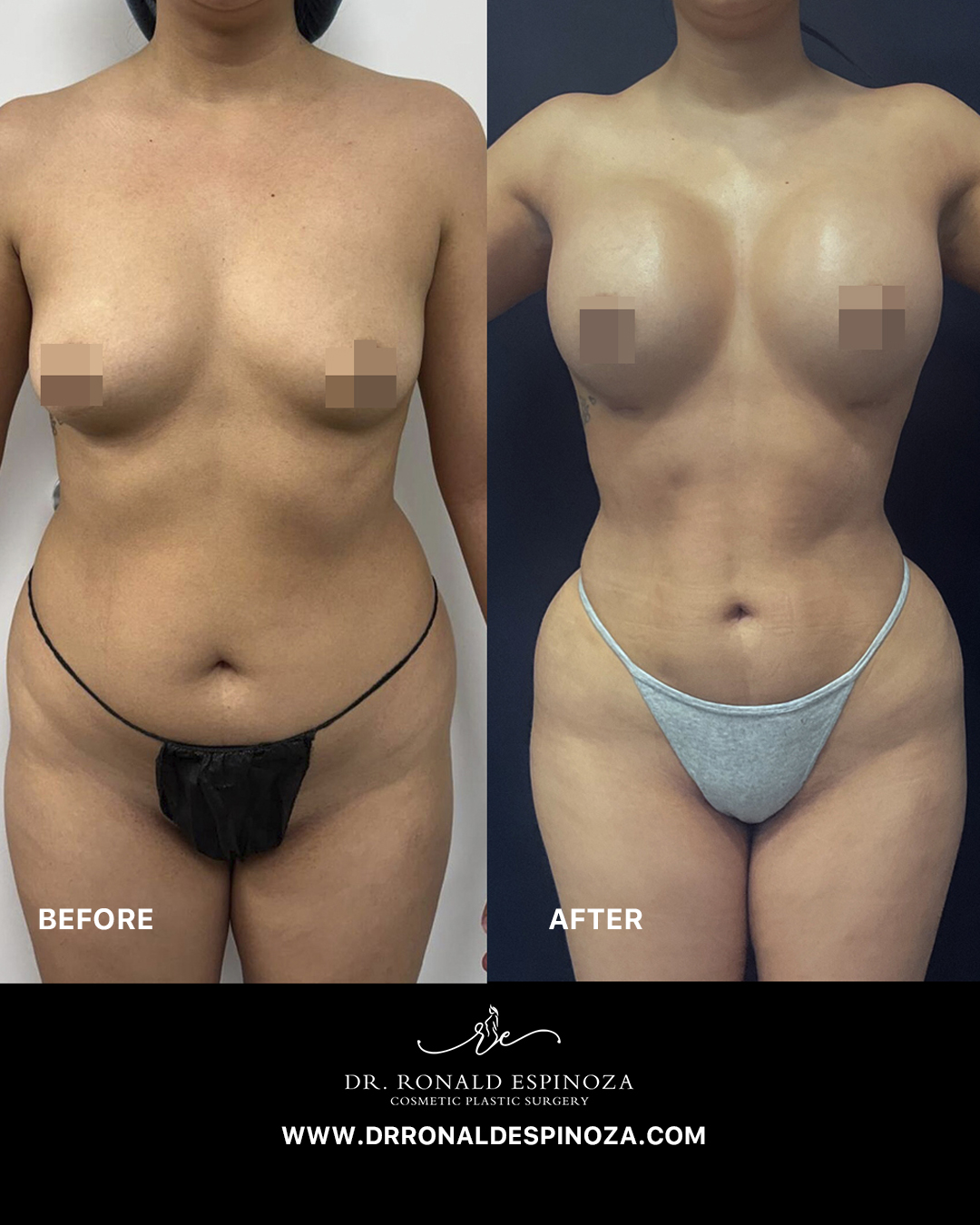 Before and after breast augmentation, front view, by Dr. Ronald Espinoza