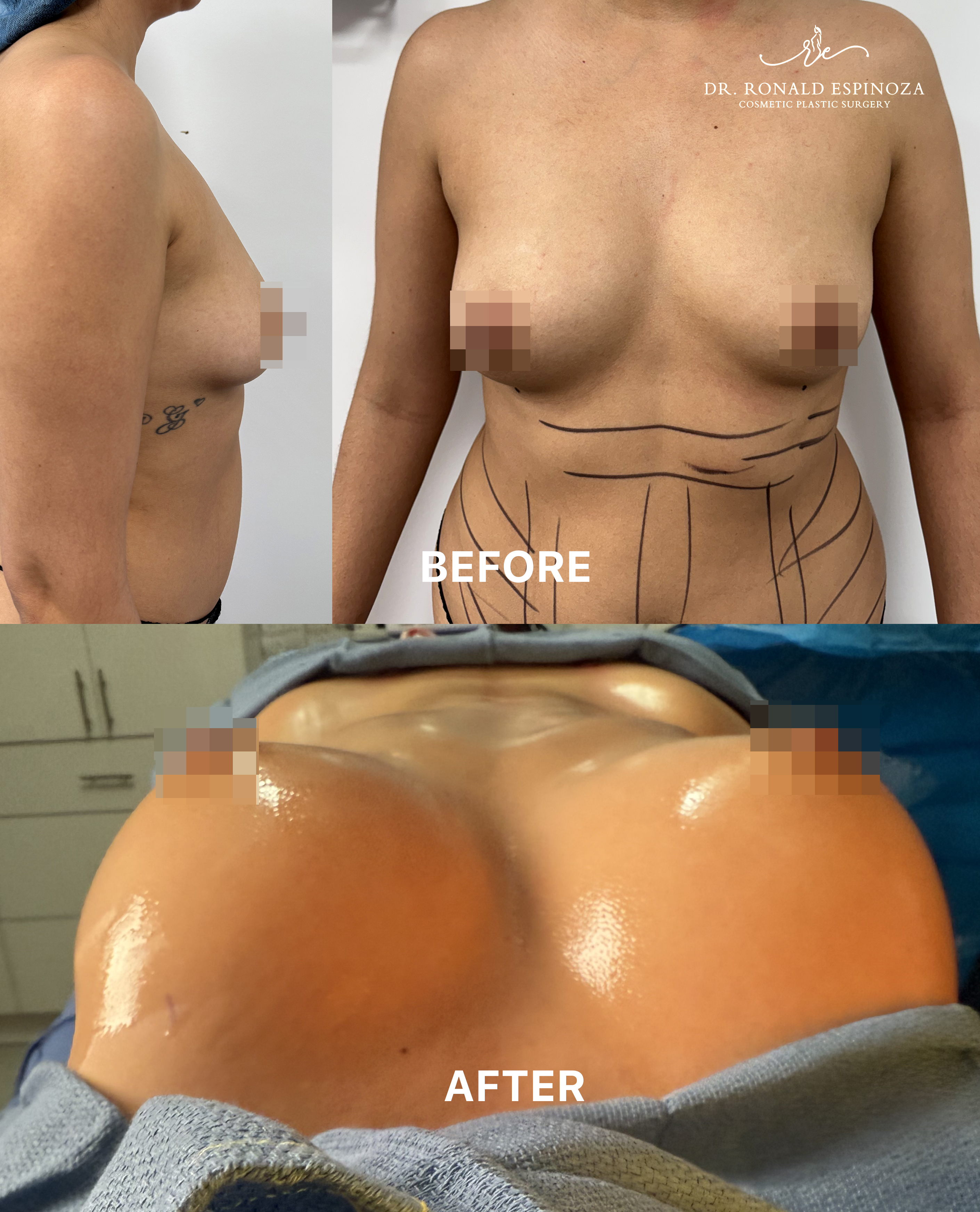 Before and after liposuction and Brazilian butt lift by Dr. Ronald Espinoza