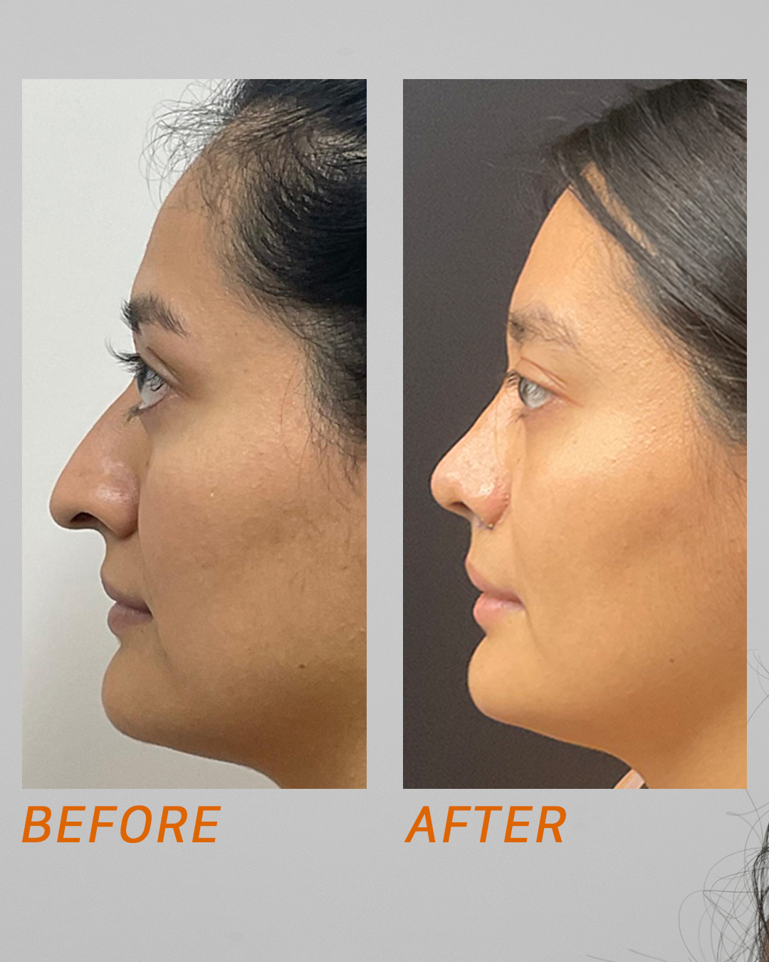 Before and after rhinoplasty profile view by Dr. Ronald Espinoza