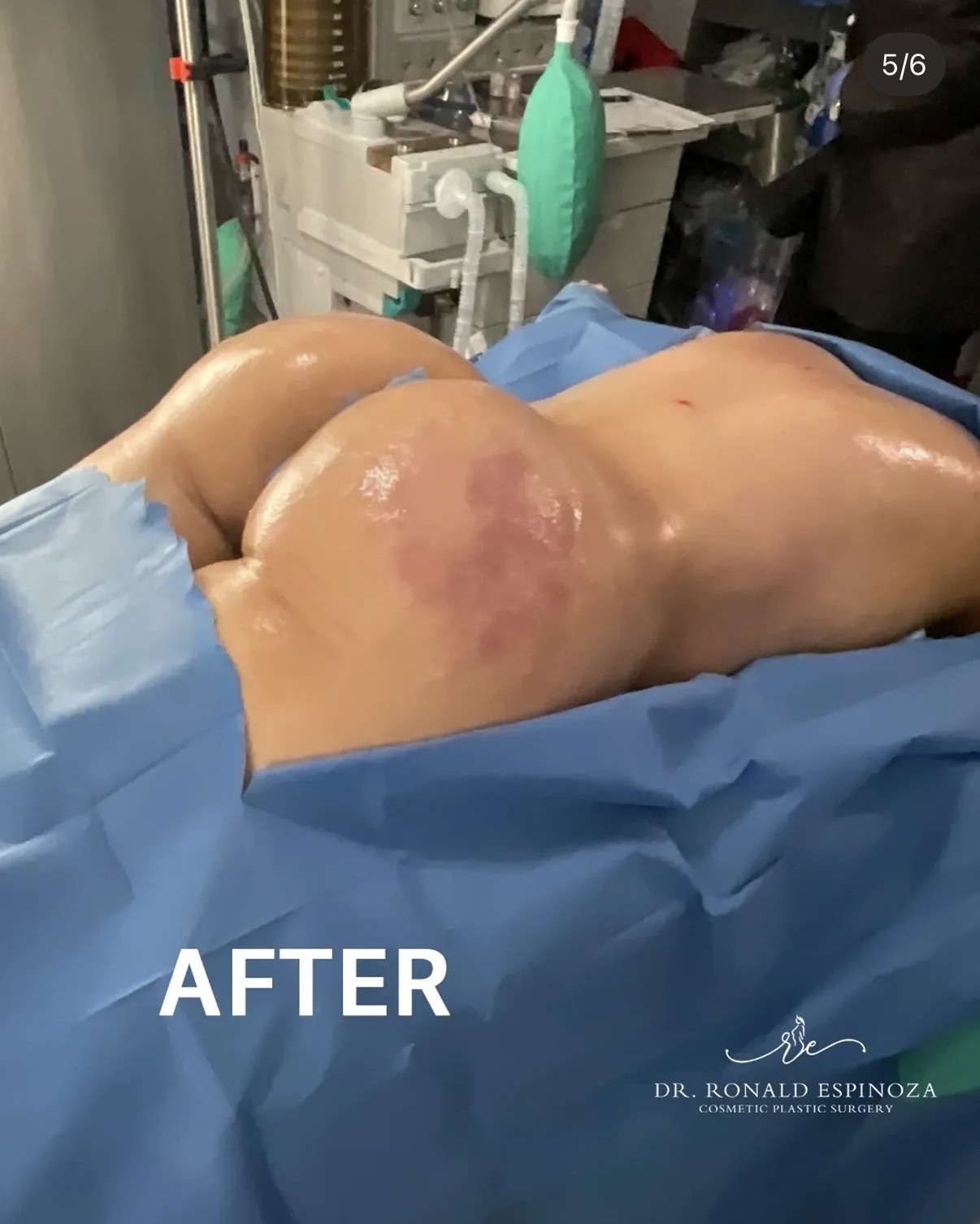 After Lipo 360 and BBL, side view, by Dr. Ronald Espinoza