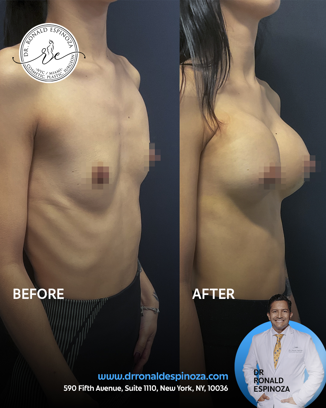Before and after breast augmentation, side view, by Dr. Ronald Espinoza