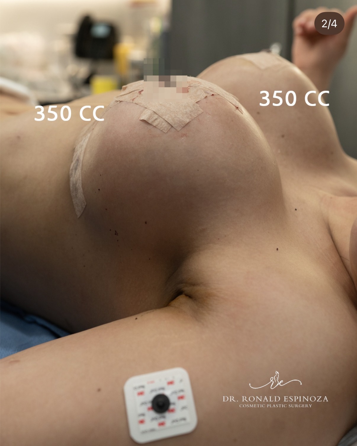 350 cc breast augmentation result by Dr. Ronald Espinoza