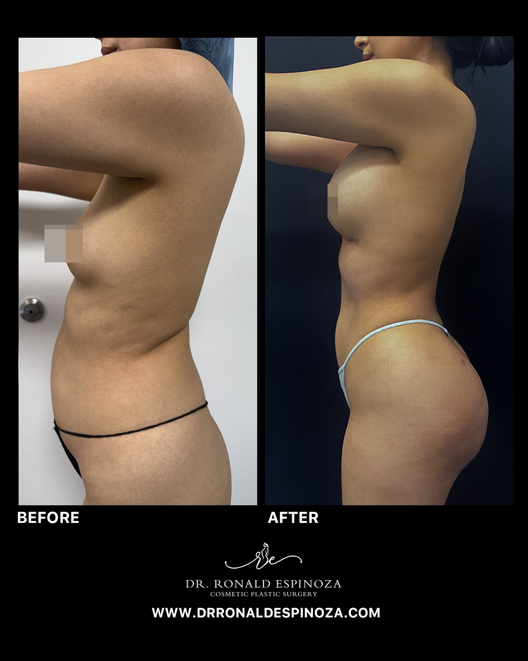 Before and after tummy tuck profile view by Dr. Ronald Espinoza