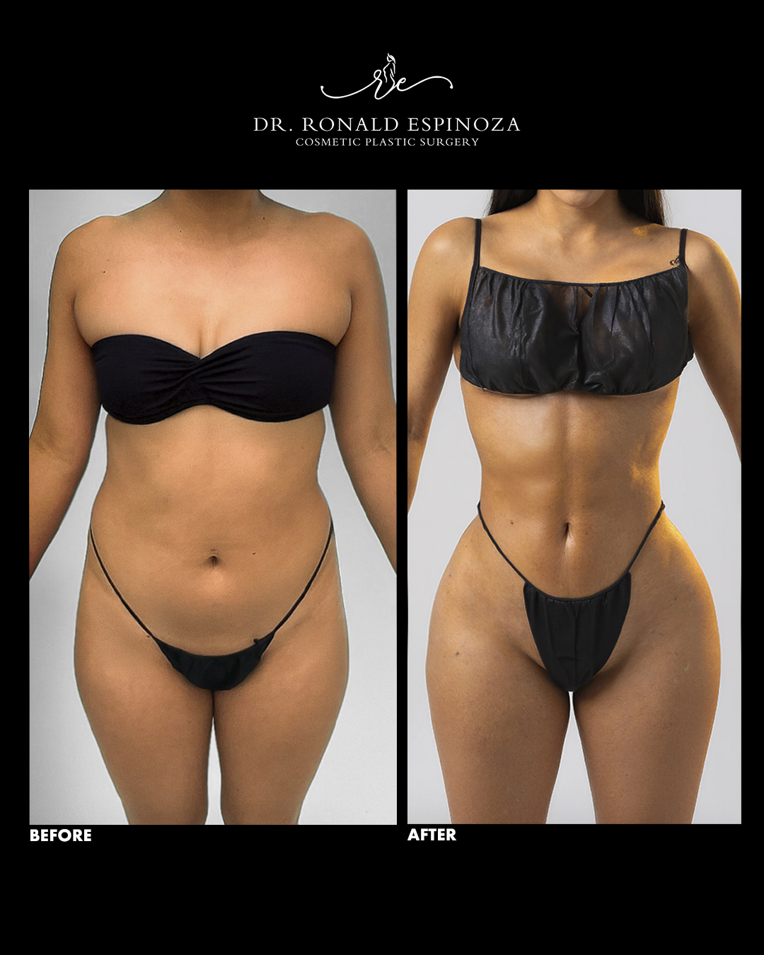 Before and after full body contouring, front view, by Dr. Ronald Espinoza
