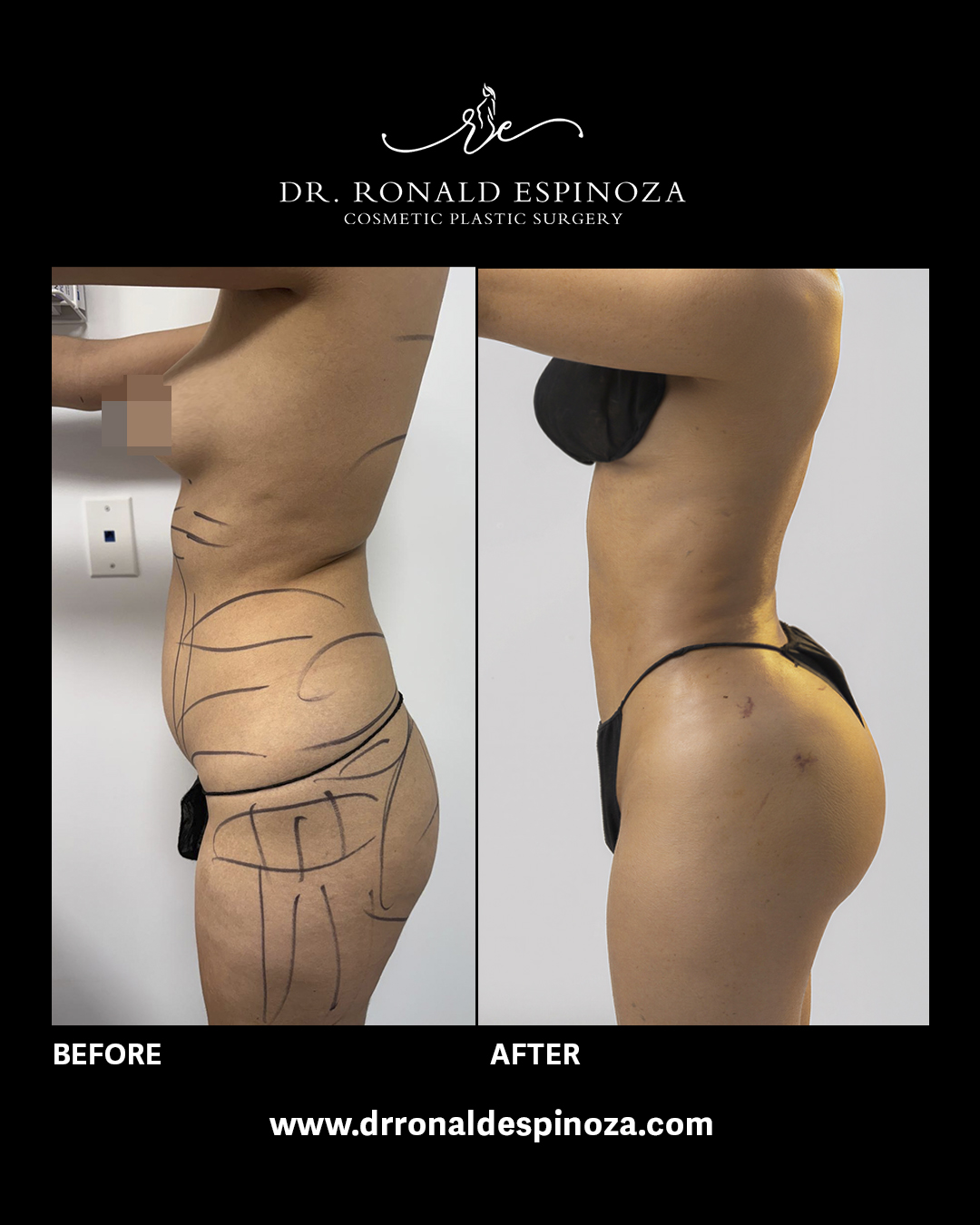 Before and after liposuction with fat transfer, side view, by Dr. Ronald Espinoza