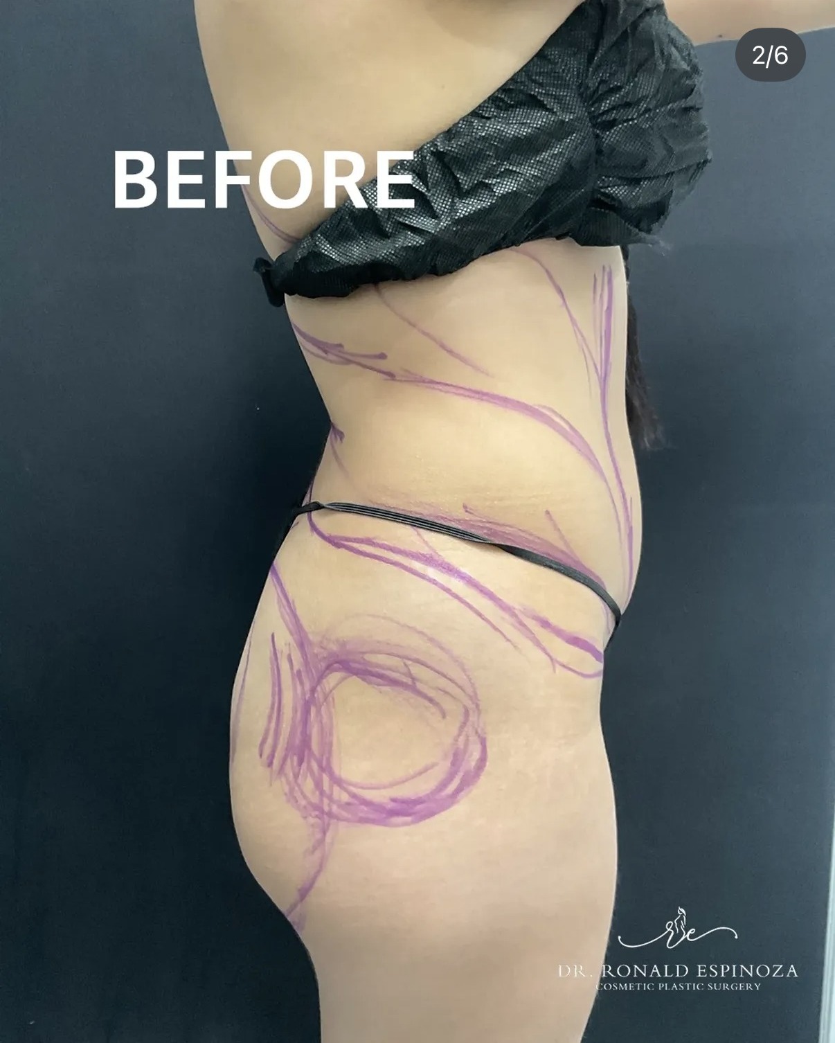 Before photo with Lipo 360 surgical markings by Dr. Ronald Espinoza