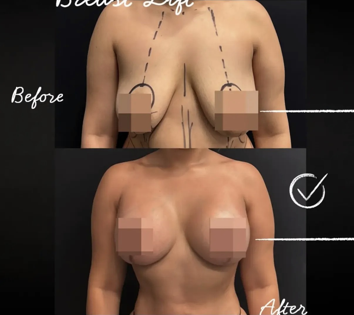 Breast Lift case photograph by Dr. Ronald Espinoza