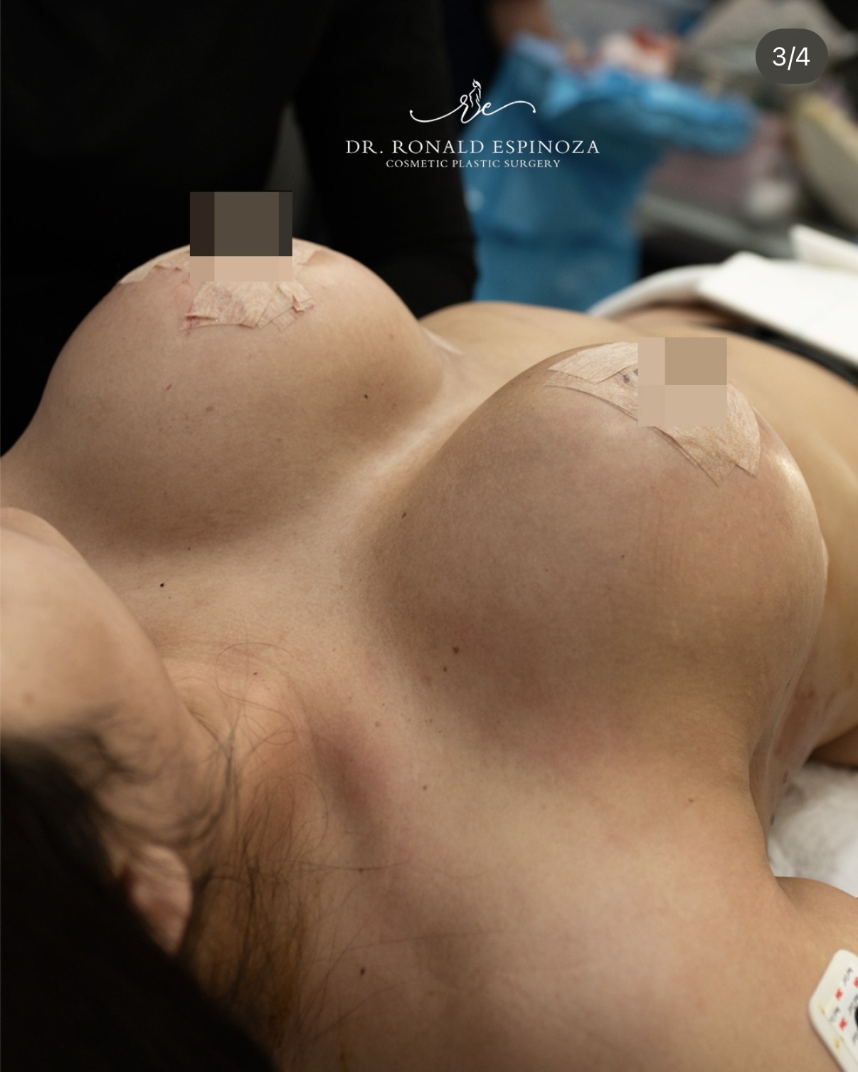 Breast augmentation result in the operating room by Dr. Ronald Espinoza